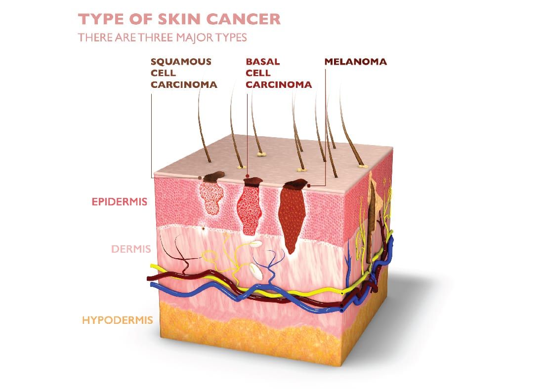 Skin Cancer » Roosevelt, Ut - Uintah Basin Medical Center - Uintah 